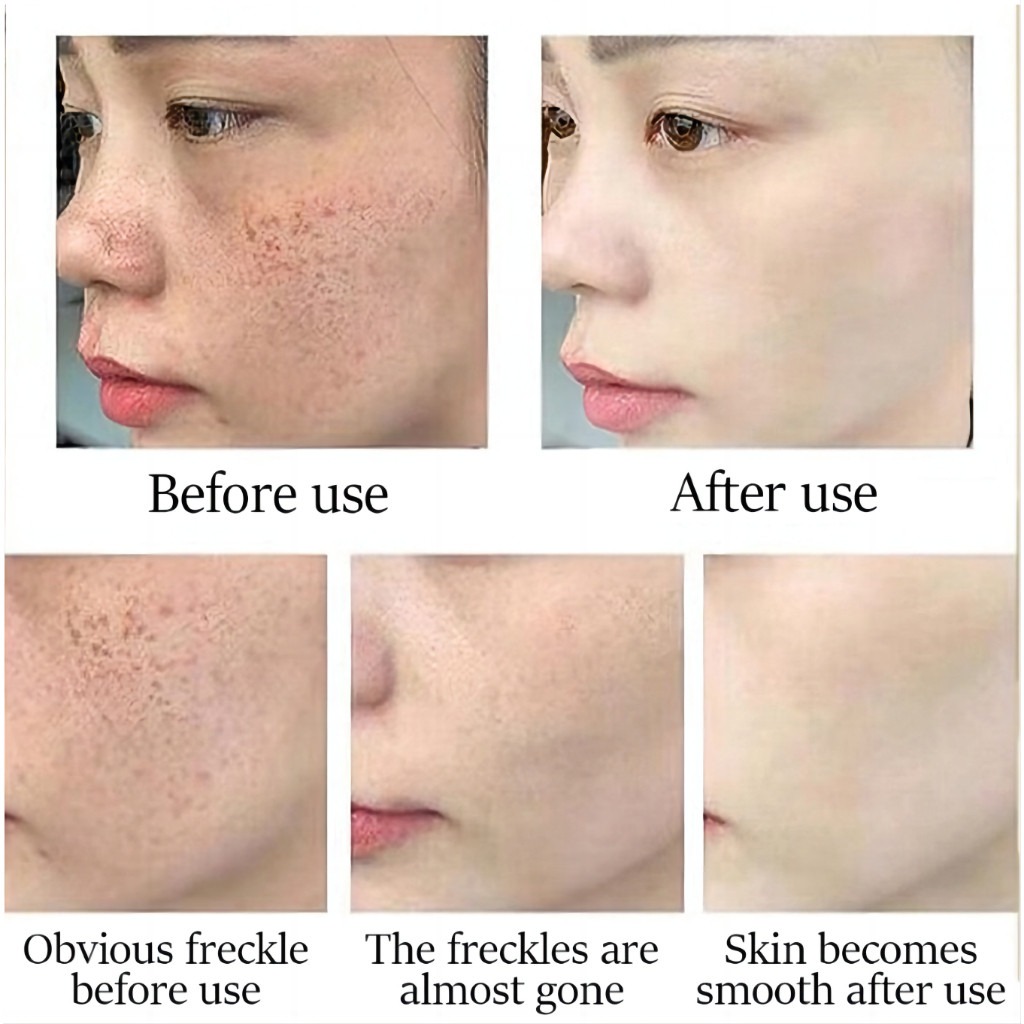 FreeShipping Philippines BUY 2 TAKE 3 Japanese Melasma Cream Yunnan Herbal Whitening Freckle Cream Original Whitening remover cream for face effective anti-aging