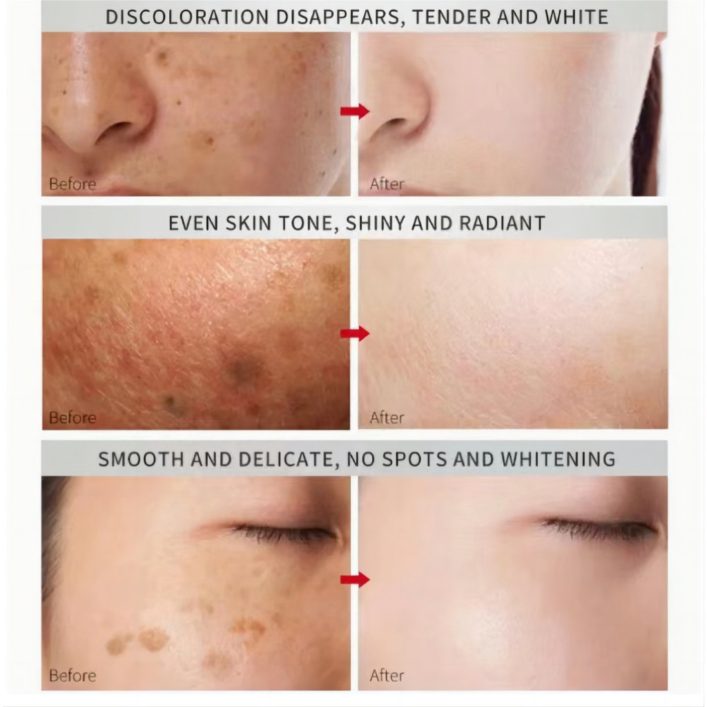 FreeShipping Philippines BUY 2 TAKE 3 Japanese Melasma Cream Yunnan Herbal Whitening Freckle Cream Original Whitening remover cream for face effective anti-aging